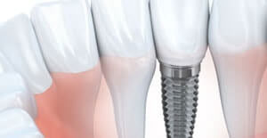 Dental Implants Cumming, GA