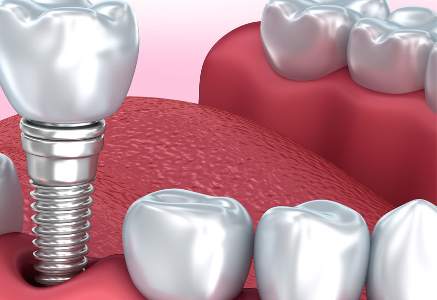 Dental Implants Cumming, GA