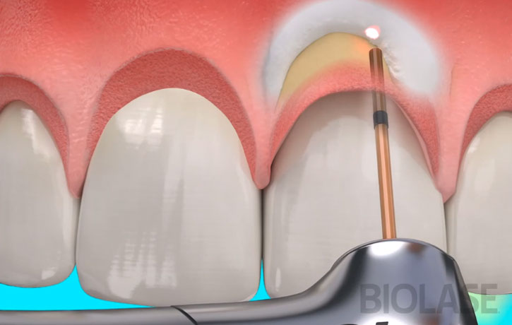 Laser Gum Treatment Cumming, GA