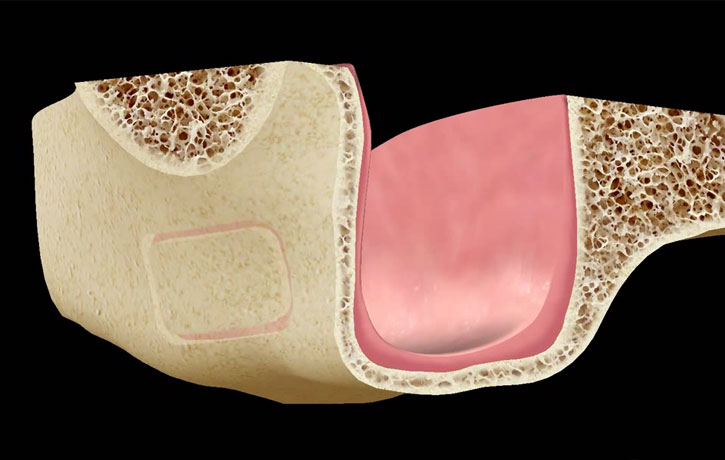 Sinus Lift Cumming, GA