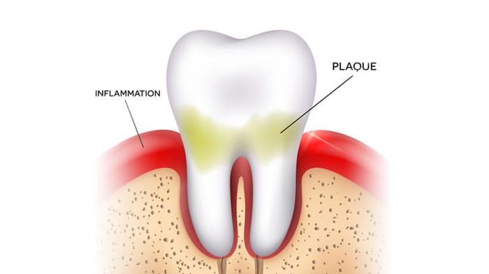 Gum Disease Treatment Cumming, GA