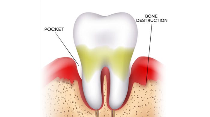 Gum Disease Treatment Cumming, GA