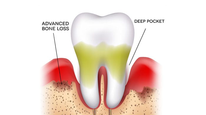 Gum Disease Treatment Cumming, GA